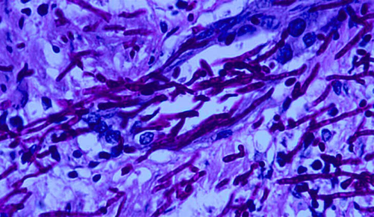 грибковая инфекция под микроскопом