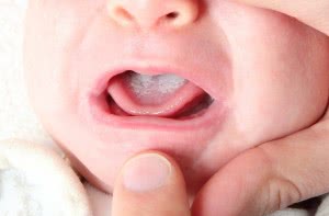 Молочница у грудного ребенка во рту