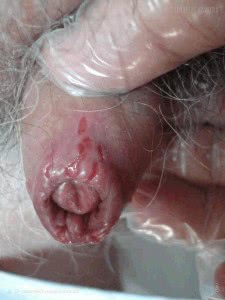 Симптомы молочницы у мужчин