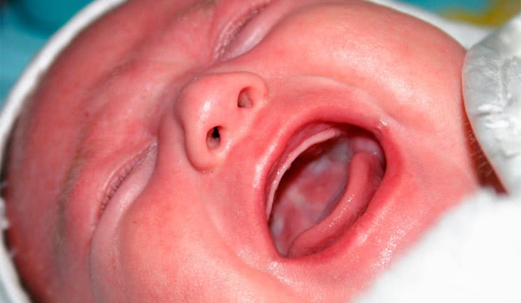 Лечение молочницы у месячного ребенка