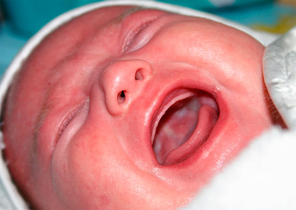 Молочница на миндалинах у ребенка фото