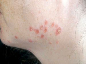 Кандидоз кожи