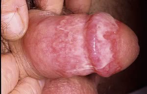 Кандидоз у мужчин после антибиотика лечение thumbnail