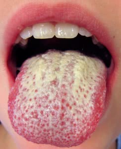 Молочница на языке