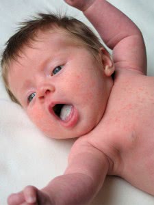Как вылечить молочницу у месячного ребенка thumbnail