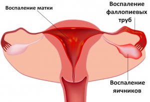 Воспаление матки и яичников