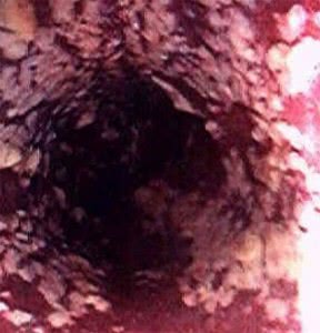 кандидоз пищевода