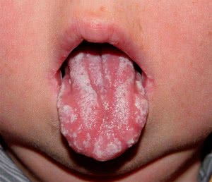 Витамин в12 молочница у детей во рту thumbnail