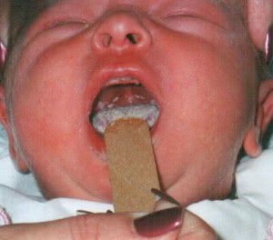 кандидоз во рту у новорожденного