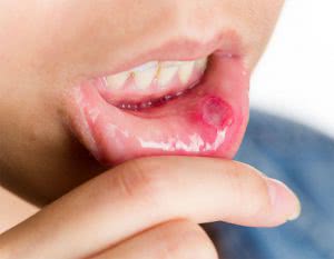 Кандидозный стоматит у взрослого