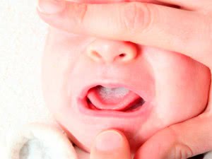 Как лечить молочницу во рту у годовалого ребенка thumbnail