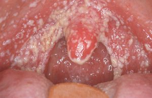 Кандидоз во рту (кандидозный стоматит)